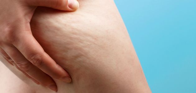 Cellulite: Current Understanding and Treatment