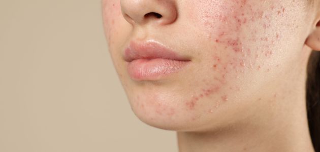 Treating Atrophic Acne Scars: Read the Scar First