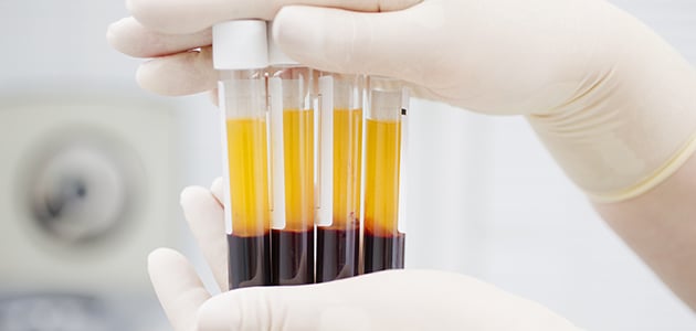 The Ultimate Secret – Platelet-Rich Plasma