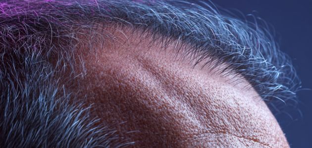 Alopecia and ethnic variations: evidence based treatments with a focus on traction alopecia treatments